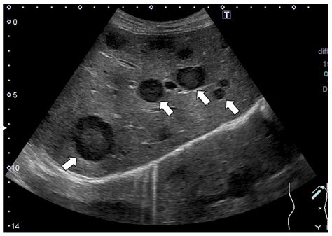 Liver Cancer Ultrasound