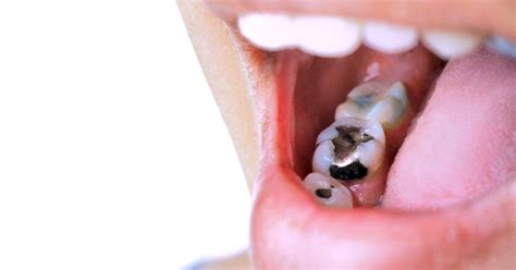 Dental Cavities: A Complete Guide