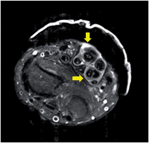 Contrast-enhanced MRI showing hypertrophy of the synovial sheath on the ...