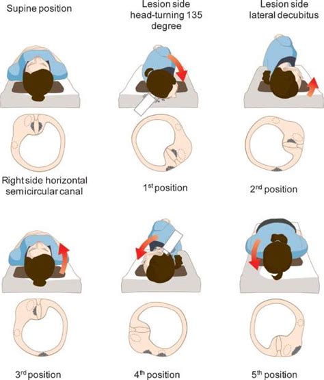 Horizontal Canal BPPV - Vestibular First