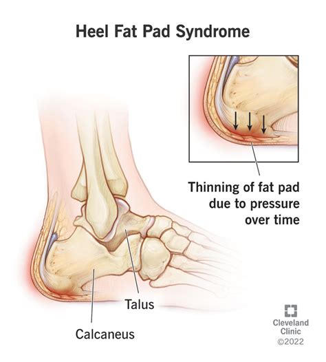 Heel Fat Pad Syndrome: Symptoms, Causes Treatment | atelier-yuwa.ciao.jp