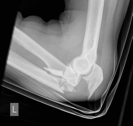 Olecranon Fossa X Ray