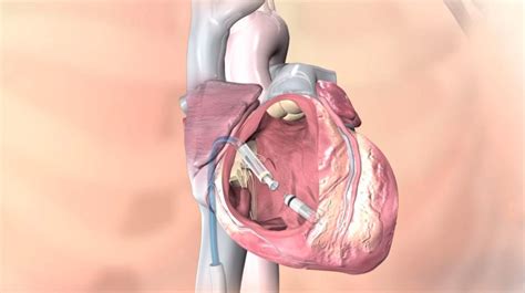 Leadless Pacemaker Treatment – Dr Vivek Kumar Cardiologist