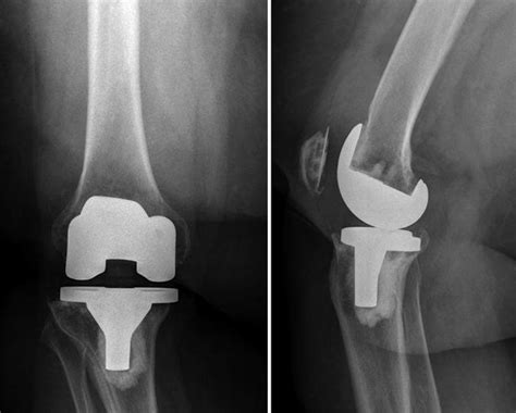 Causes and Diagnosis of Aseptic Loosening After Total Knee Replacement ...