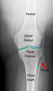 Distal Femur Fracture Classification