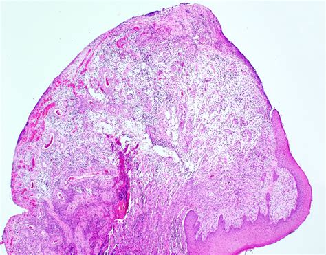 Oral Pyogenic Granuloma Histology