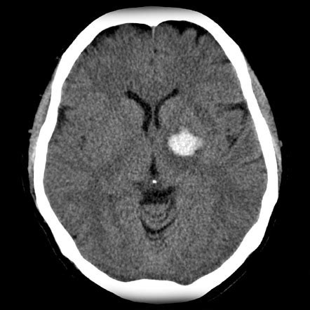 Basal ganglia hemorrhage | Radiology Reference Article | Radiopaedia.org