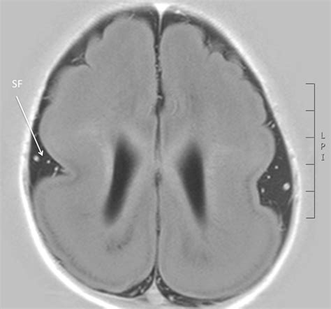 LISSENCEPHALY