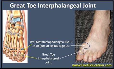 Great Toe Interphalangeal Joint Arthritis - FootEducation