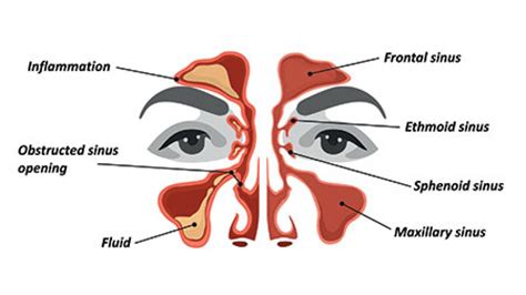 Frontal Sinus Headache