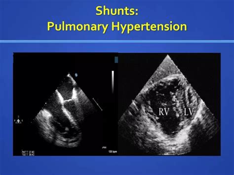 PPT - Shunts: Pulmonary Hypertension PowerPoint Presentation, free download - ID:2837082