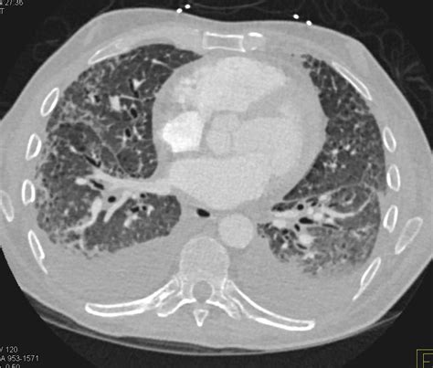 Pulmonary Edema Ct Scan Ct Scan Machine | Images and Photos finder