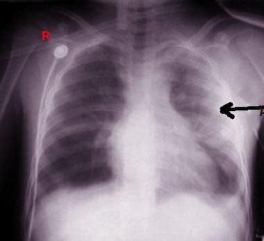 [Figure, Pulmonary Contusion Radiograph. This image shows ...