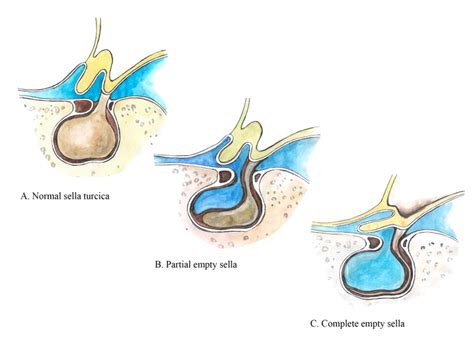 Hecho para recordar reunirse Roble empty sella syndrome symptoms ...