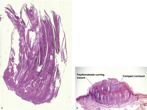 Filiform Wart Histology