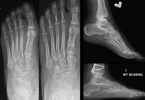 Metatarsal Bone Fracture