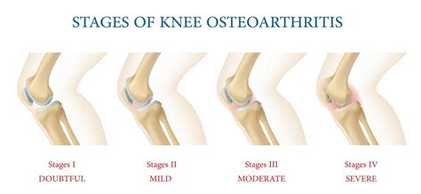 Knee joint osteoarthritis stages infographics 21565064 Vector Art at ...