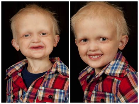 HEDBoyBeforeAndAfter | National Foundation for Ectodermal Dysplasias