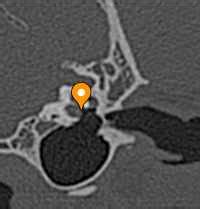 Membrana timpânica^secundária - vet-Anatomy - IMAIOS