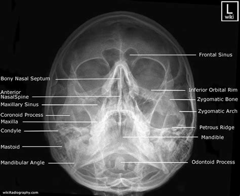 Waters view of maxillary sinus | Facial bones, Medical radiography, Radiology