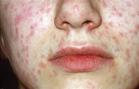 Measles rash on the face of a patient