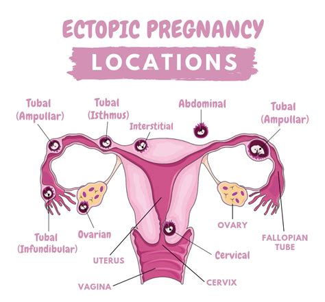 Ectopic Gestation (Pregnency) – Lancet laparoscopy center