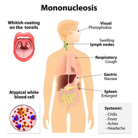 Infectious Mononucleosis Symptoms - Goimages 411