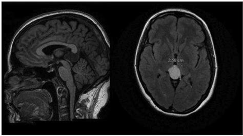 The microsurgical management of benign pineal cysts: Helsinki ...