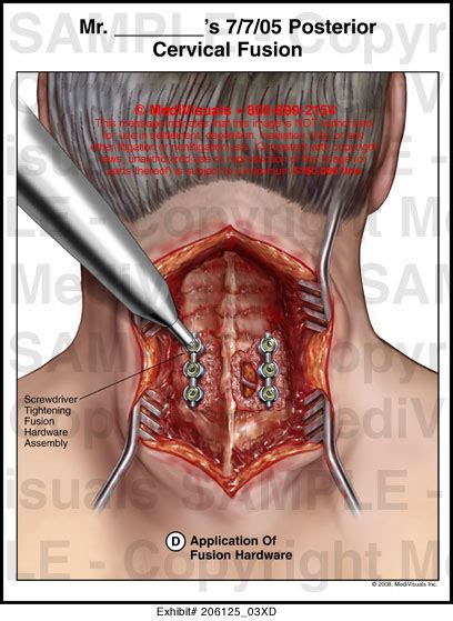 Medivisuals Posterior Cervical Fusion Medical Illustration