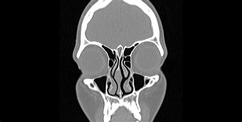 Chronic sinusitis – imaging your sinuses - Dr Jeeve ENT Specialist