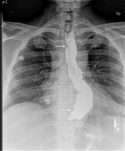 Upper GI series showed a tight GEJ with a long intramural sinus... | Download Scientific Diagram