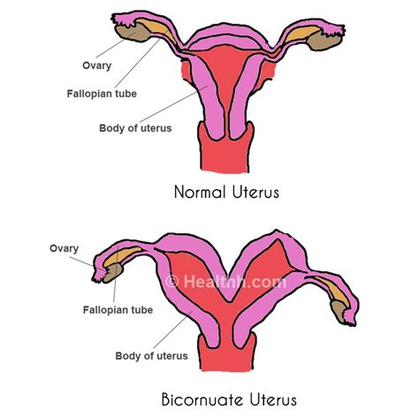 Bicornuate Uterus - Symptoms, Pictures, Causes, Treatment