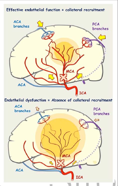 Anterior Cerebral Artery Stroke