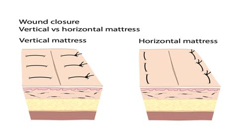 Suture Techniques - RCEMLearning India