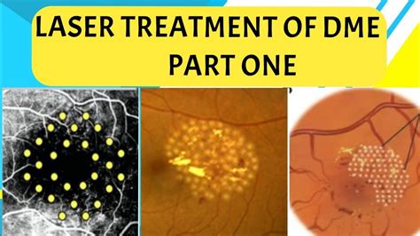 LASER TREATMENT for DIABETIC MACULAR EDEMA - PART 1 focal, grid, modified grid laser and more ...