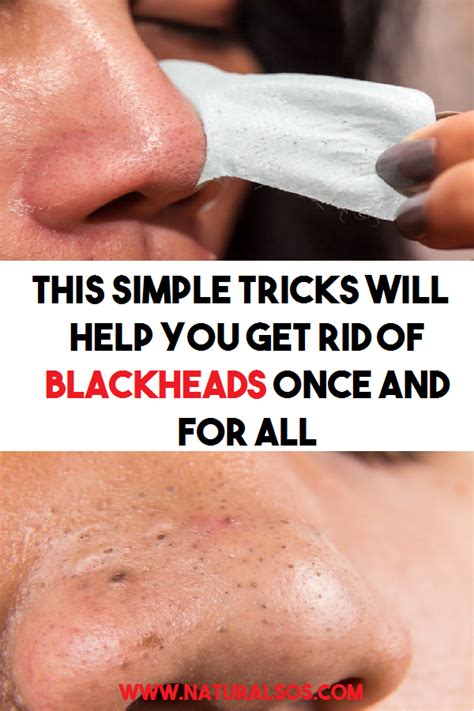 THIS SIMPLE TRICKS WILL HELP YOU GET RID OF BLACKHEADS ONCE AND FOR ALL | Get rid of blackheads ...