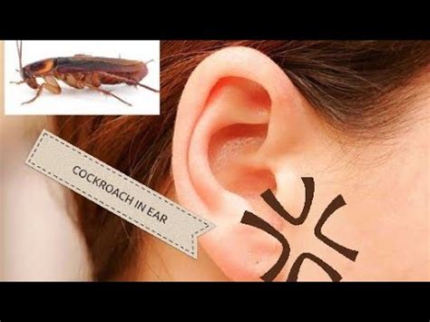 Earwax Removal Cockroach On Ear - YouTube