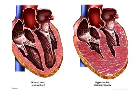 Demographics of Hypertrophic Cardiomyopathy Patients Appear to Be Changing - U.S. Medicine