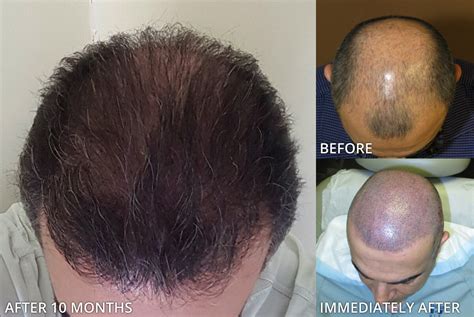 Before and After Picutres | ARTAS - Robotic Hair Transplant