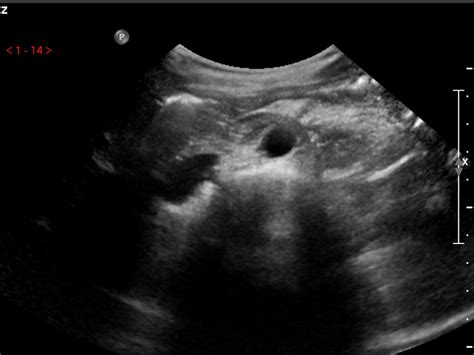 Inferior Mesenteric Artery Ultrasound