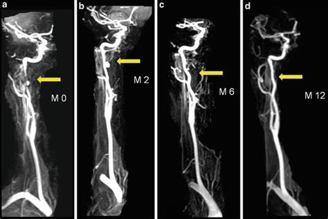 Internal Carotid Artery Mri