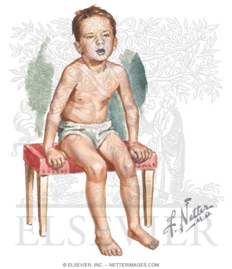 mytest: 17: Tripod Position Child Epiglottitis