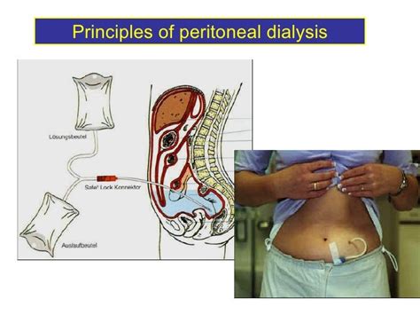 11 Peritoneal Dialysis