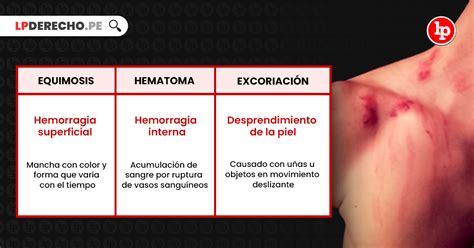 Diferencias entre equimosis, hematoma y excoriación | LP (2023)