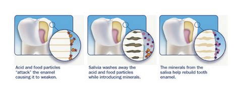 How to remineralize teeth | News | Dentagama