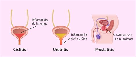 Infecciones urinarias de las vías bajas