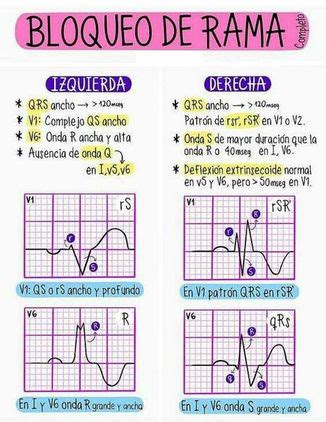 Cooperación familia Derecho bloqueo de rama derecha sintomas ...