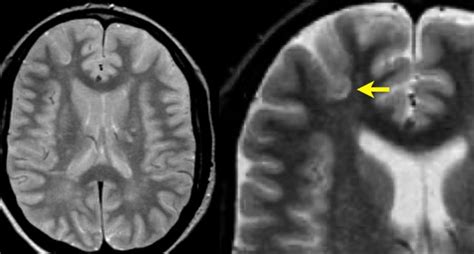 Ms Brain Mri With Contrast