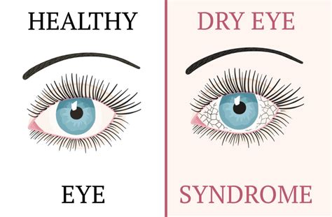 What Is Chronic Dry Eye | Toronto, ON | See & Be Seen Eyecare