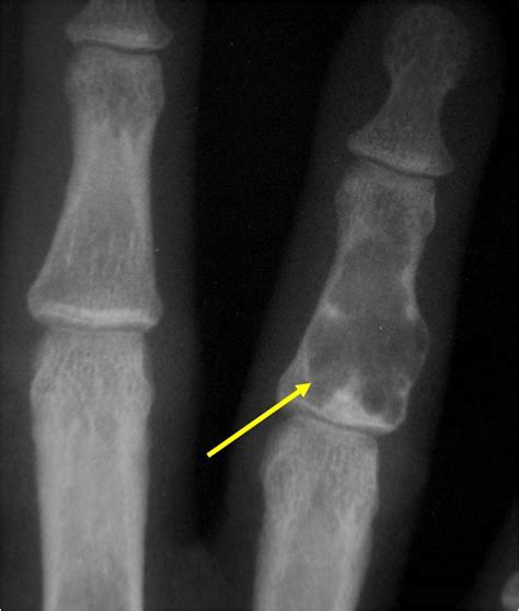 Enchondroma : Benign Bone Tumor: Tumors of Bone